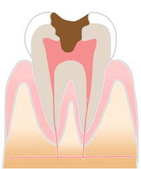 虫歯の症状3