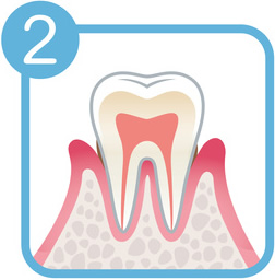 歯周病の症状2